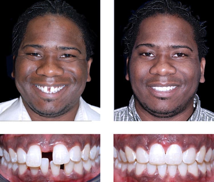 Adult Invisalign
