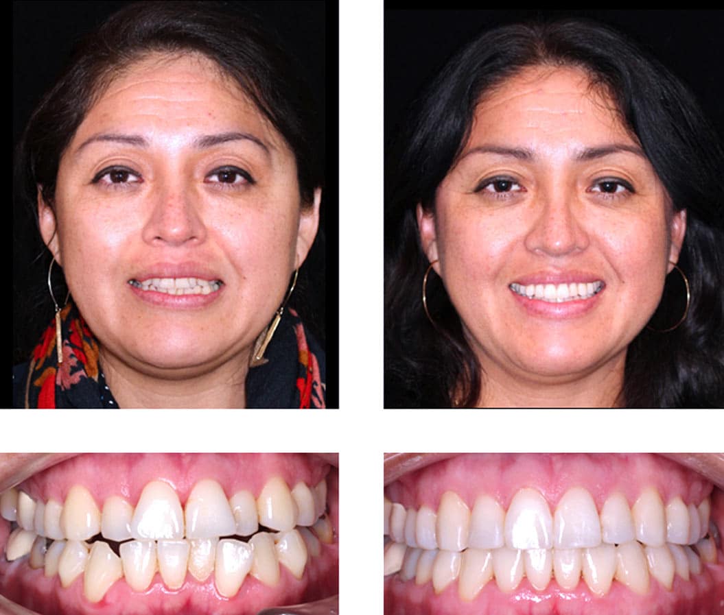 Adult Invisalign