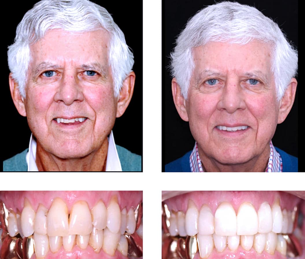 Adult Invisalign - Before and After