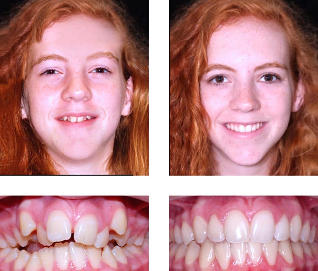 Invisalign for Teens